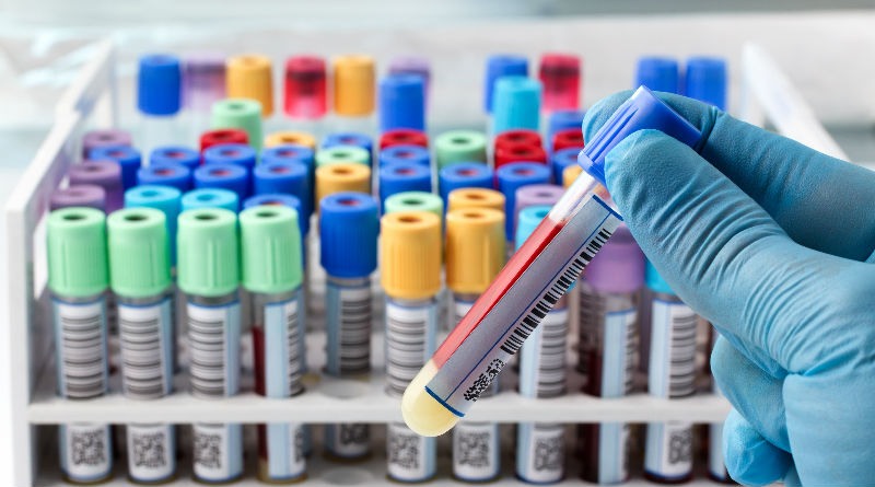 Monocitos Altos en Sangre: Comprende Síntomas, Causas y Opciones de Tratamiento Efectivas