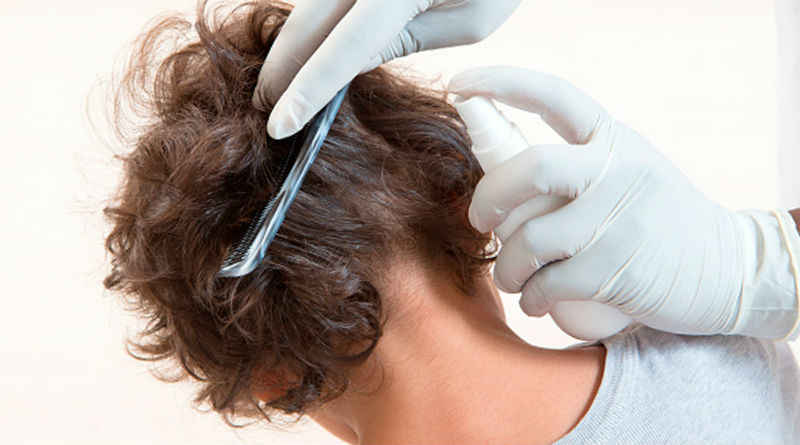 Los productos más efectivos para eliminar los piojos de forma segura y rápida