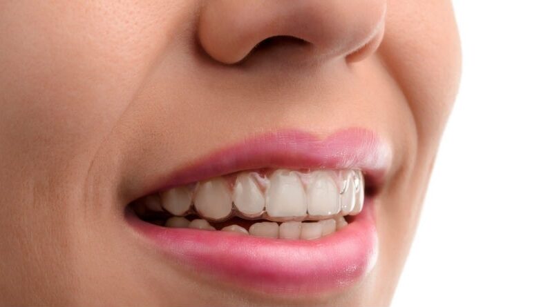 Todo lo que necesitas saber sobre la ortodoncia invisible Invisalign: beneficios, tratamiento y cuidados