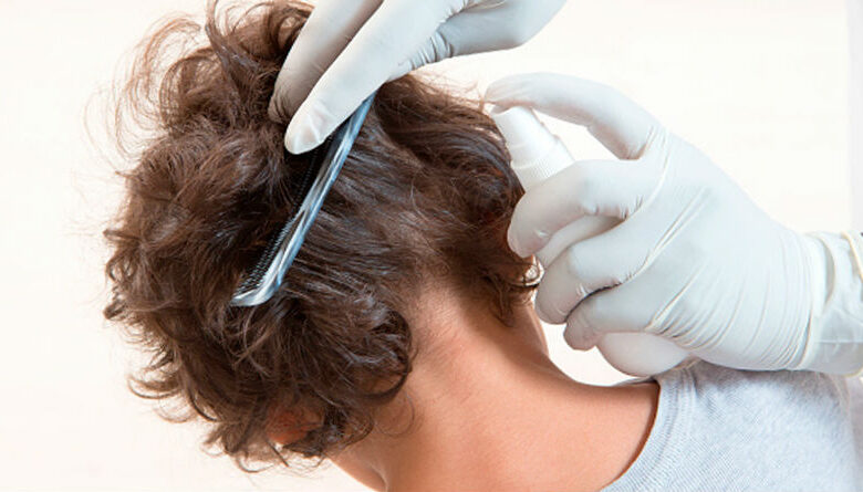 Los productos más efectivos para eliminar los piojos de forma segura y rápida